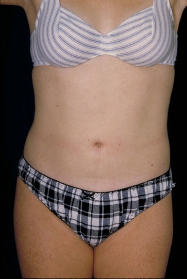 After Image: Liposuction - front
