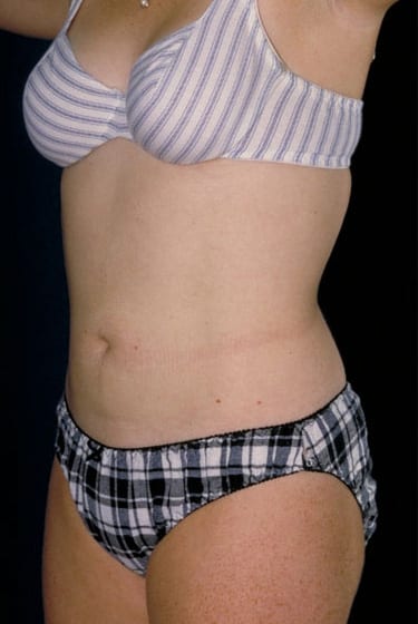 After Image: Liposuction - left-front-oblique