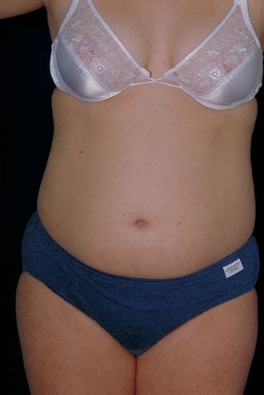 Before Image: Liposuction - front