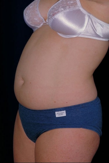 Before Image: Liposuction - left-front-oblique
