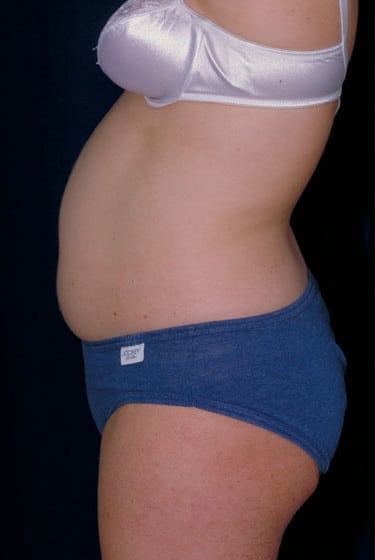 Before Image: Liposuction - left-side