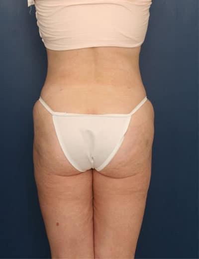 After Image: Liposuction - back