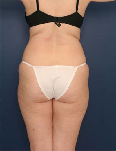 Before Image: Liposuction - back