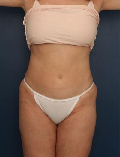 After Image: Liposuction - front