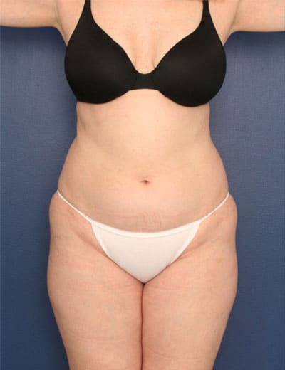 Before Image: Liposuction - front