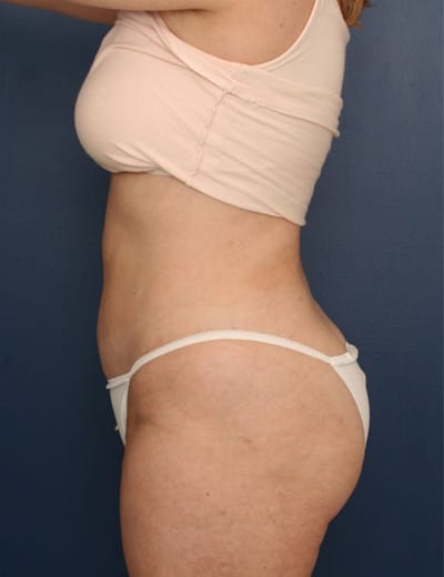 After Image: Liposuction - left-side