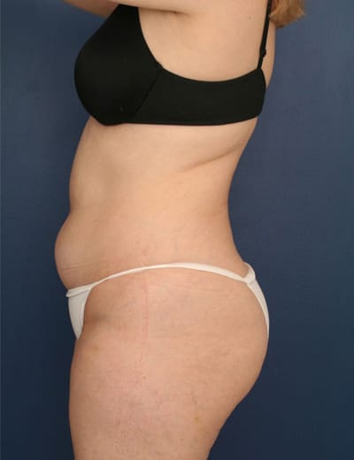Before Image: Liposuction - left-side
