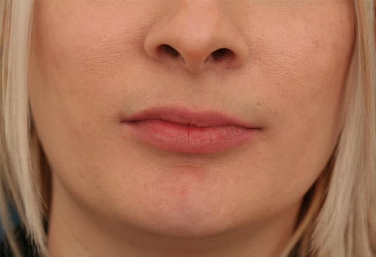 Before Image: Lips Defyne - front