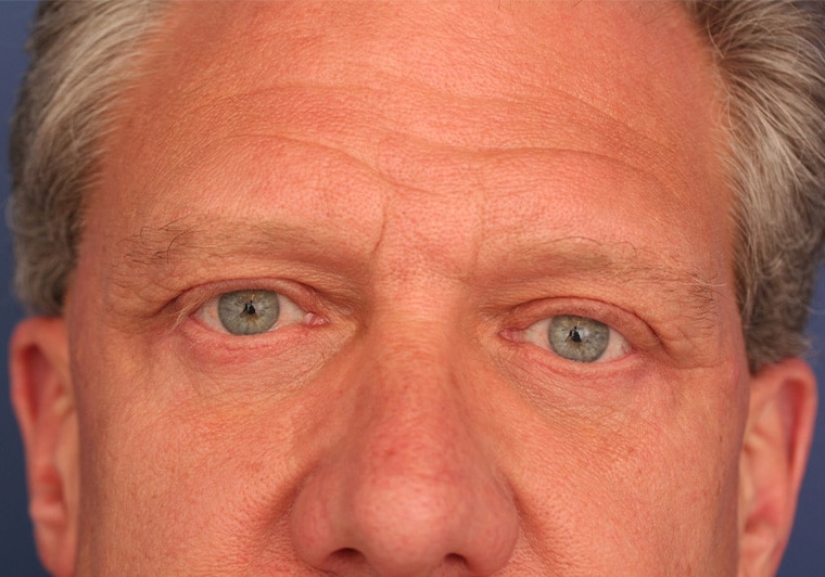 After Image: Eyelid Surgery - front