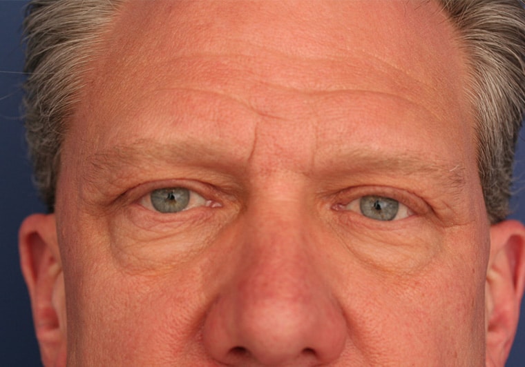 Before Image: Eyelid Surgery - front