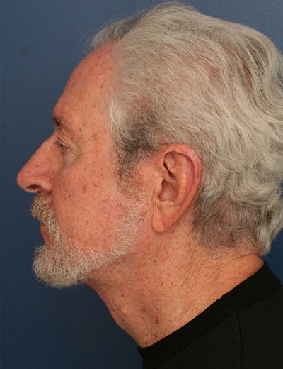 After Image: Neck Lift - left-side