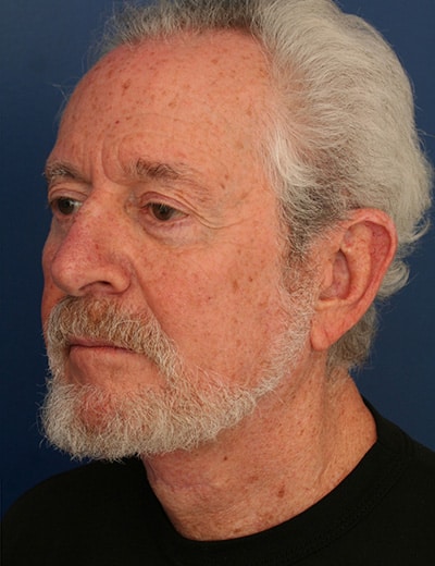 After Image: Neck Lift - left-front-oblique