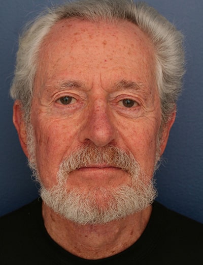 After Image: Neck Lift - front
