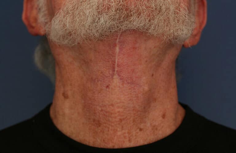 After Image: Neck Lift - front