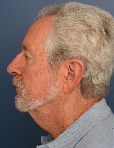 Before Image: Neck Lift - left-side