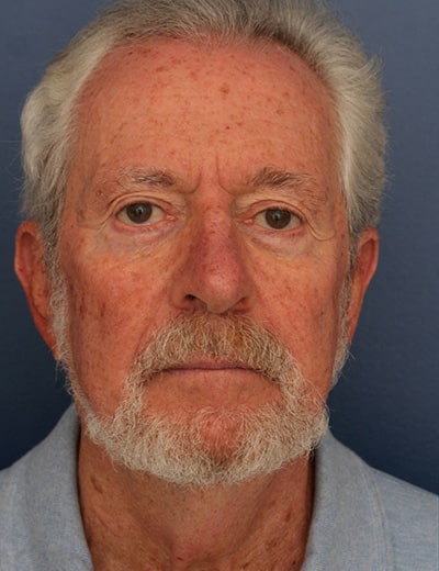 Before Image: Neck Lift - front