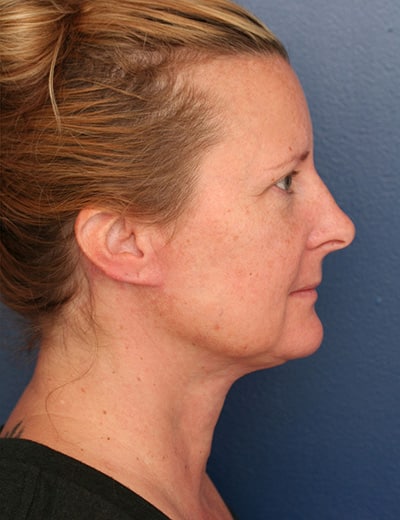 After Image: Neck Lift - right-side