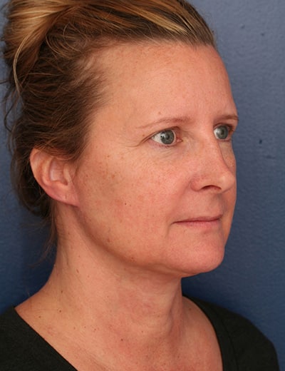 After Image: Neck Lift - right-front-oblique