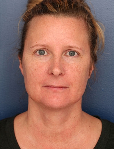 After Image: Neck Lift - front