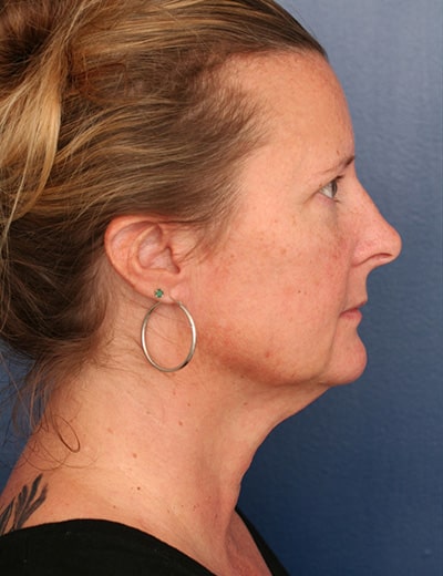 Before Image: Neck Lift - right-side
