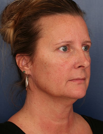 Before Image: Neck Lift - right-front-oblique