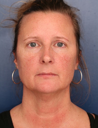 Before Image: Neck Lift - front