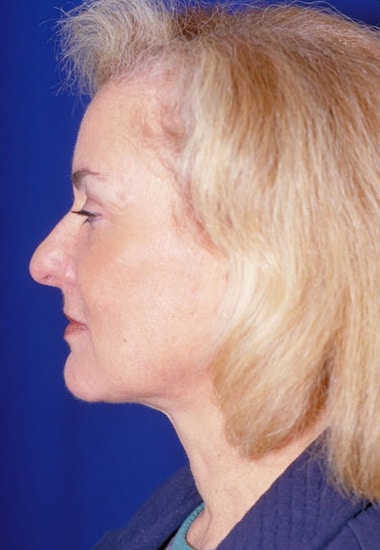After Image: Neck Lift - left-side