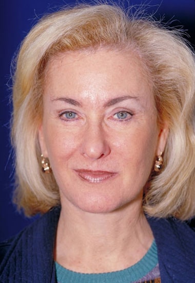 After Image: Neck Lift - front