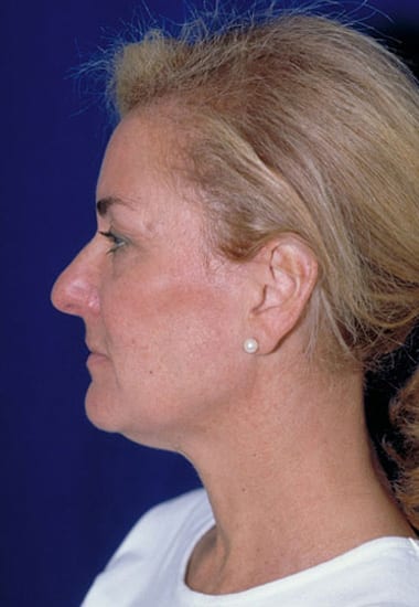 Before Image: Neck Lift - left-side