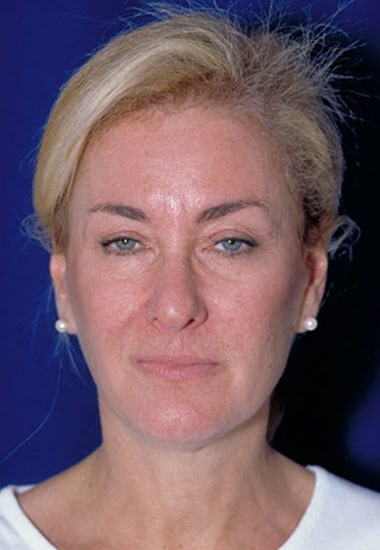 Before Image: Neck Lift - front