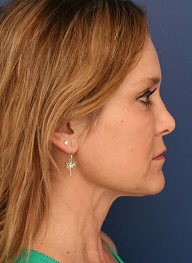 After Image: Neck Lift - right-side
