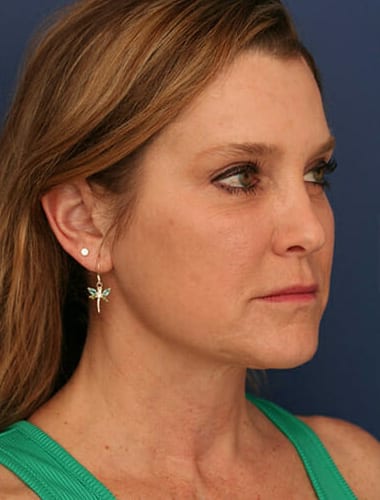 After Image: Neck Lift -