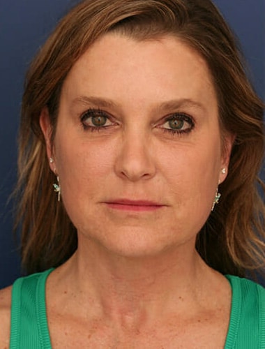 After Image: Neck Lift -