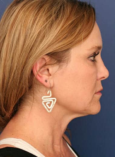 Before Image: Neck Lift - right-side