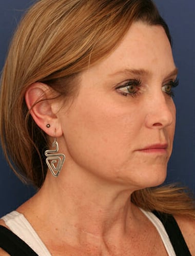 Before Image: Neck Lift -