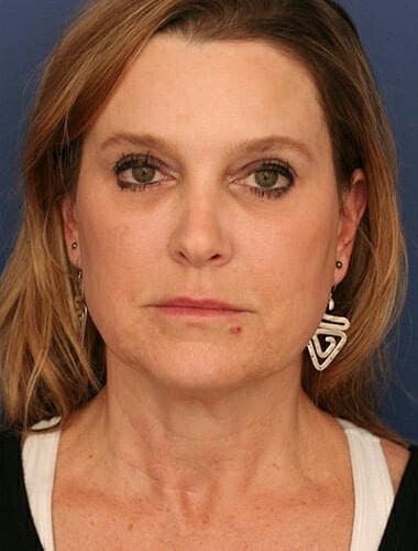 Before Image: Neck Lift -