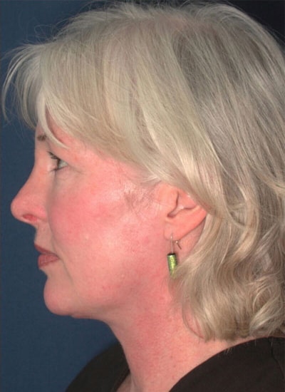 After Image: Neck Lift - left-side