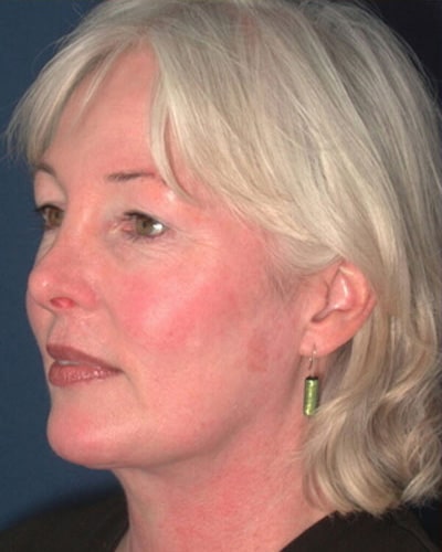 After Image: Neck Lift - left-front-oblique