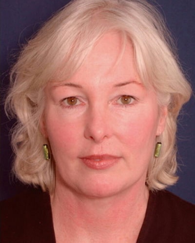 After Image: Neck Lift -