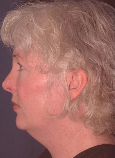 Before Image: Neck Lift - left-side