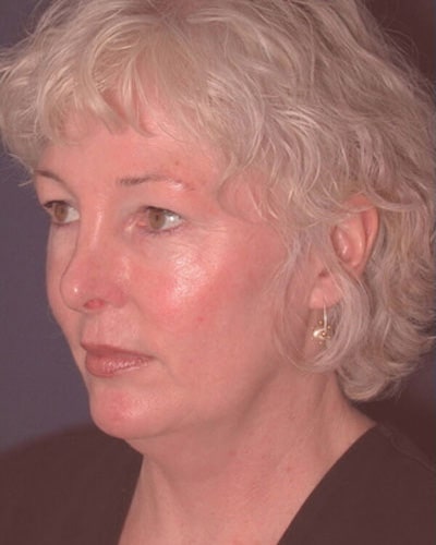 Before Image: Neck Lift - left-front-oblique