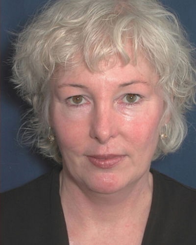 Before Image: Neck Lift -