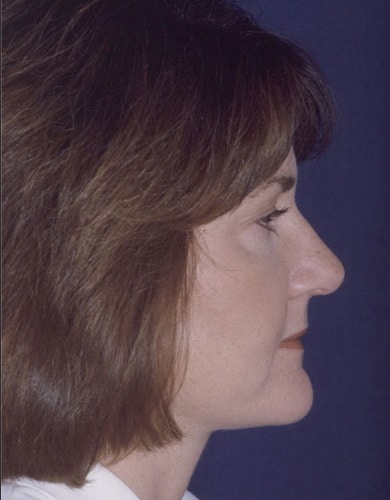 After Image: Neck Lift - right-side