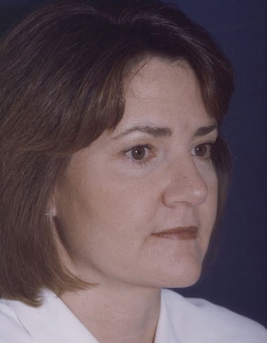 After Image: Neck Lift - right-front-oblique