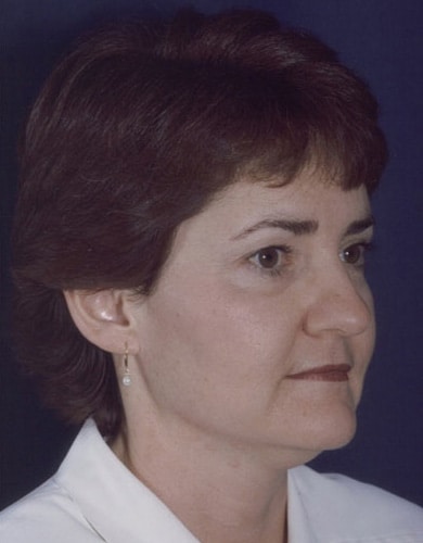 Before Image: Neck Lift - right-front-oblique