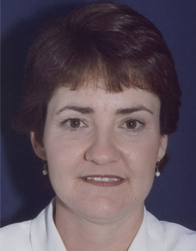 Before Image: Neck Lift - front