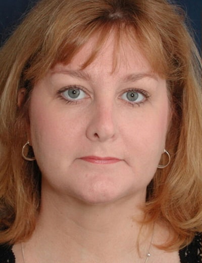 After Image: Neck Lift - front