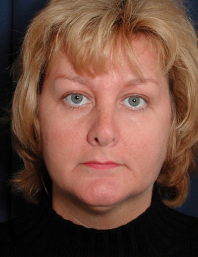Before Image: Neck Lift - front