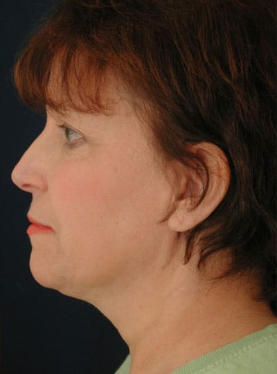 After Image: Neck Lift - left-side
