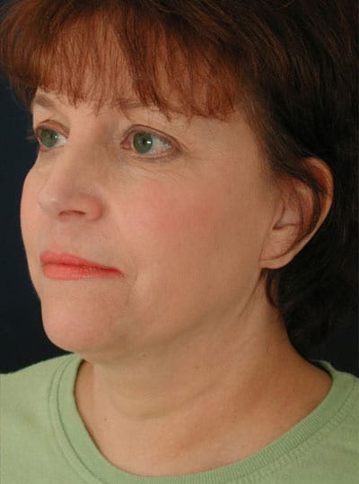 After Image: Neck Lift - left-front-oblique